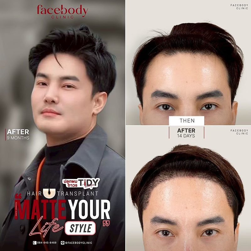 ปลูกผมราคา 2569 ถาวร เทคนิค iFUE / TiDY / ADVANCE TiDY โดยแพทย์อเมริกันบอร์ด ABHRS